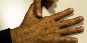 desinformacao-sobre-cancer-de-pele-afeta-diagnostico,-diz-instituicao