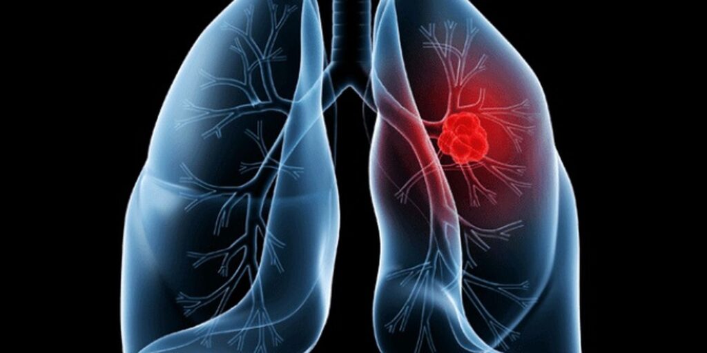 saiba-o-que-e-adenocarcinoma-pulmonar,-cancer-que-atinge-o-papa-leao