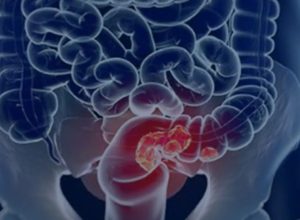 pacientes-com-cancer-colorretal-sao-diagnosticados-em-estagio-avancado